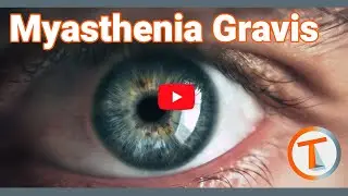 Myasthenia Gravis
