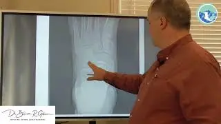 Accessory Navicular