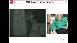 VI CONGRESO SEEP. Epilepsias autoinmunes. Tiziana Granata
