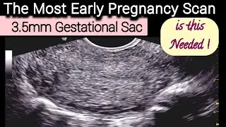 3.5mm Gestational Scan - The Most Early Pregnancy TVS Ultrasound