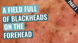 A Field Full of Blackheads on Aimilios’s Forehead - Part 1 out of 4