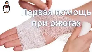 Первая помощь при ожогах