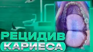 Клинический случай лечения рецидива кариеса 46 зуба с полным восстановлением его анатомической формы