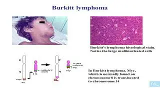 Virus et Lymphomes partie 11: lymphome de Burkitt