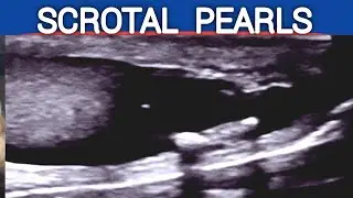 Scrotal PEARLS | Ultrasound | Causes | Association with Infertility and Oligospermia