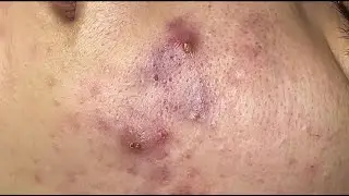 Inflammatory acne hematoma, hidden acne (Tham P.1) #HoangMySpa108