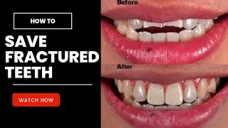 🤡🤡Broken Teeth Filling process | save Fractured tooth | Your Dentist