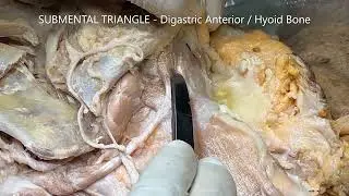 ANTERIOR CERVICAL REGION STRAP MUSCLES NECK TRIANGLES and Clinical Aspects – Sanjoy Sanyal