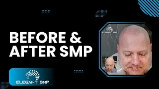 Before and After Scalp Micropigmentation Archive