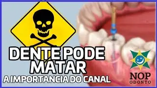Você sabe como é um tratamento de CANAL??