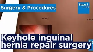 How keyhole inguinal hernia repair surgery is carried out | Bupa Health