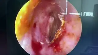 Tympanoplasty is microsurgery ― surgery using endoscope