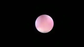 URS by HoYAG Laser for ureteric calculi