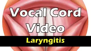 Vocal cords of a person with hoarse voice