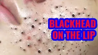 How To Treat a Blackhead On The Lip