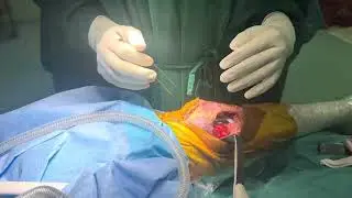 Subvastus approach in knee replacement