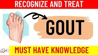 What is GOUT | All you need to know | Causes | Symptoms | Diagnosis | Treatment | Prevention