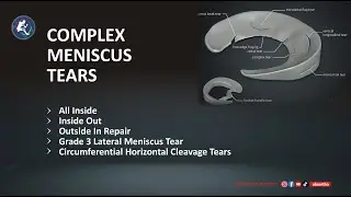 3 Different Technique to Repair Complex Meniscus Tear