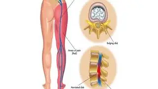 साइटिका क्या है? || What is Sciatica ? || Sciatica Exercises || Back Pain Exercise | Kamar ka Dard