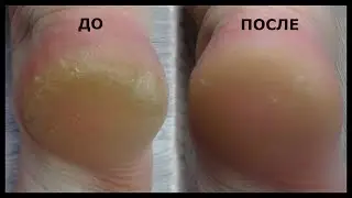 ТРЕЩИНЫ НА ПЯТКАХ, НАТОПТЫШИ, СУХИЕ МОЗОЛИ!!! ШОК!!! СУПЕР СРЕДСТВО!!! КАК ИЗБАВИТЬСЯ ОТ НАТОПТЫШЕЙ