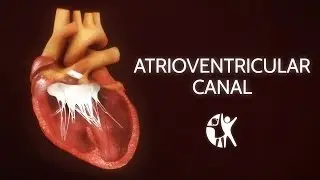 Atrioventricular Septal Defect - AV Canal