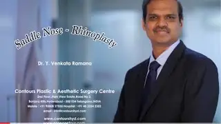 Saddle Nose Correction Rhinoplasty