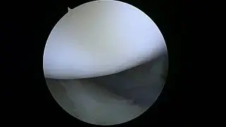 L Shoulder Rotator Cuff Repair 10 8 20 RM