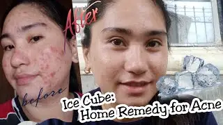 How to Get Rid of Pimples: Trying Ice Therapy to Reduce Acne I Euanne Hyuna