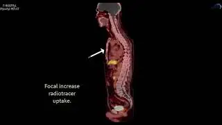 PSMA PET/CT F-18 Pylarify Case 7