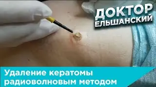 Удаление кератомы радиоволновым методом