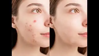 PHOTOSHOP | HOW TO REMOVE ACNE FROM PHOTOSHOP? | TOOLS