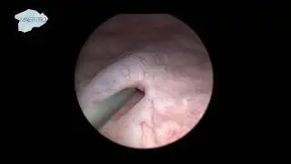 Possibility of Access Sheath Placement