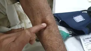 Slip Sign in Lipoma Patient