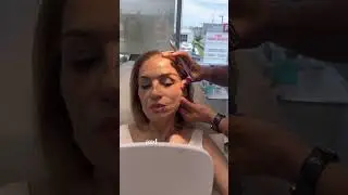 Lift with thread is good or bad - لیفت با نخ #threadlift #facelift #shorts #threadlift