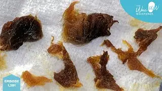 1,281 - Fully Blocked Ear Wax Removal