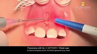 Frenectomy with the D-Storm™ Diode Laser