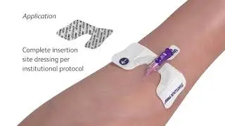 StatLock™ Pro IV Stabilization Device   Application and Removal
