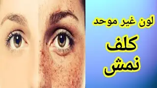 HIDROSPOT لون غير موحد،نمش و تجاعيد🧐فيتامين س للحامل و المرضع☺️طريقة و مدة استعمال هيدروسبوت🤔