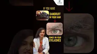 5 Causes Stye on Your Eyelid ? | How To Get Rid Of Stye From Eye | Vision Eye Centre
