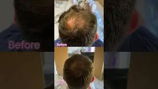 Acell And PRP Hair Loss Treatment #acell #hairloss #prp