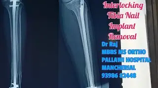 Interlocking Tibia Nail Implant removal @PallawiHospital2023 #mancherial #orthopaedicsurgeon