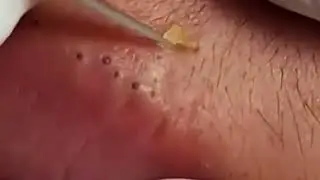 The Most Painful Blackhead Removal Video on Lips 2024