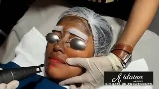 Laser Carbon Peel