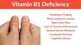 Thiamine Vit B1| Thiamine (Vit B1)Deficiency | Signs , Symptoms & Treatment