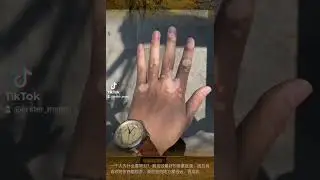 излечение #витилиго Народная медицина