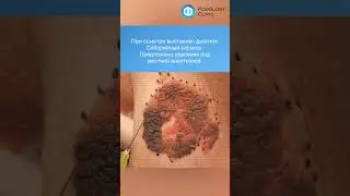 Удаление кератомы 