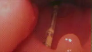 Surfaktant instillation via thin catheter - video laryngoscope