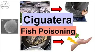 Ciguatera Fish Poisoning (Ciguatoxin) | Symptoms (Numb Feet, Diarrhea), Diagnosis, Treatment
