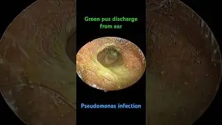 Green discharge from ear | pseudomonas infection | Antibiotics choice