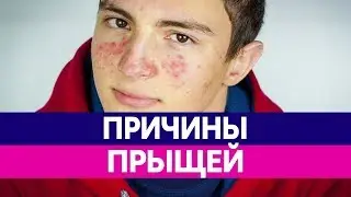 Как ИЗБАВИТЬСЯ ОТ ПРЫЩЕЙ? Причины прыщей, как убрать прыщи